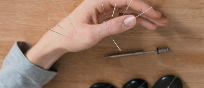 Acupunctura